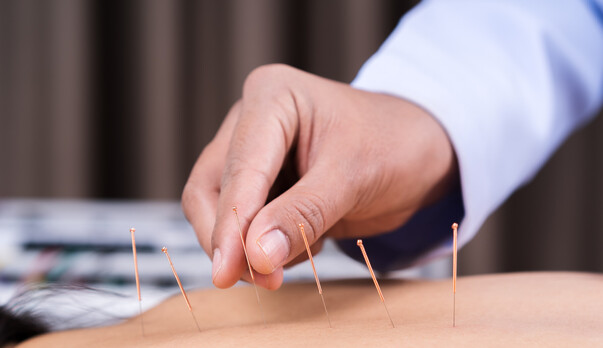Acupuncture Vs Dry Needling