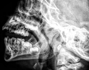 TMJ Treatment and Chiropractic