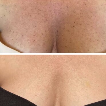 Observ Skin Analysis – Body Beautiful Retreat – Brisbane