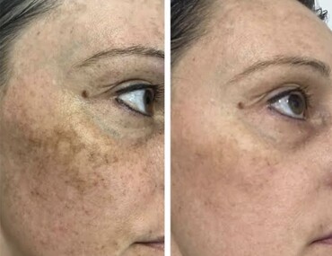 Observ Skin Analysis – Body Beautiful Retreat – Brisbane