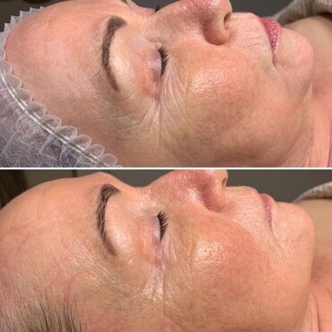 Observ Skin Analysis – Body Beautiful Retreat – Brisbane