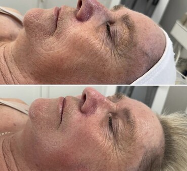 Observ Skin Analysis – Body Beautiful Retreat – Brisbane