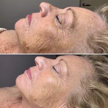 Observ Skin Analysis – Body Beautiful Retreat – Brisbane