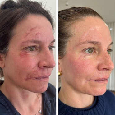 Observ Skin Analysis – Body Beautiful Retreat – Brisbane