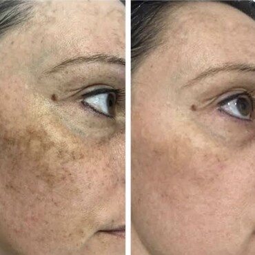 Observ Skin Analysis – Body Beautiful Retreat – Brisbane