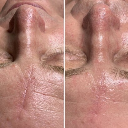 Body Beautiful Retreat | Instant Face Lift | Brisbane Beauty Salon