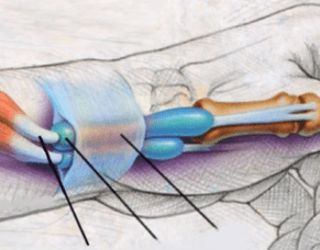 De Quervain&rsquo;s Tenosynovitis
